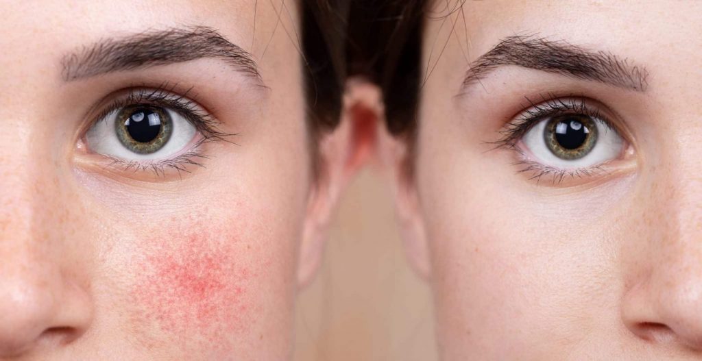 Rosacea treatment
