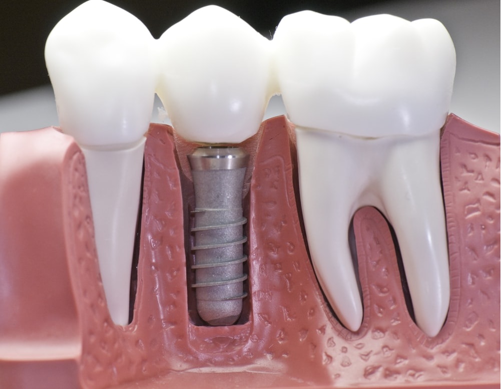 Dentist Supports